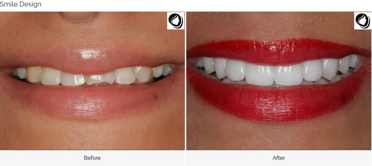 A smile Design made at GOREgeous Smiles 