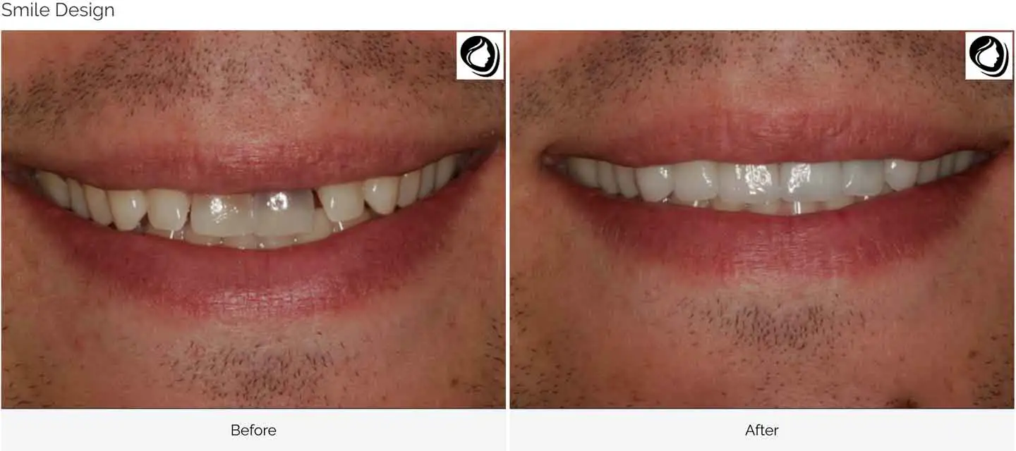 A smile Design made at GOREgeous Smiles 