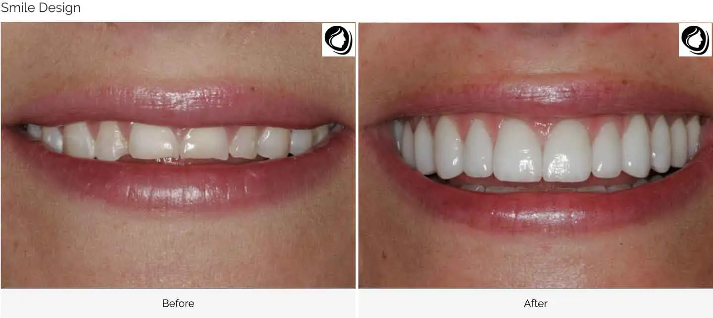 A smile Design made at GOREgeous Smiles 