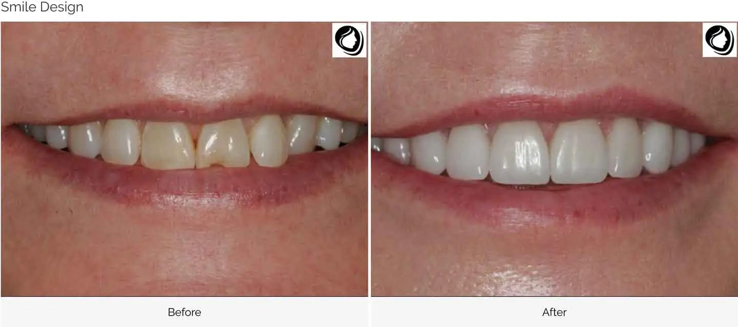 A smile Design made at GOREgeous Smiles 