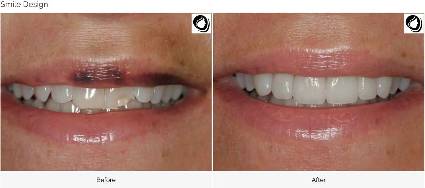 A smile Design made at GOREgeous Smiles 