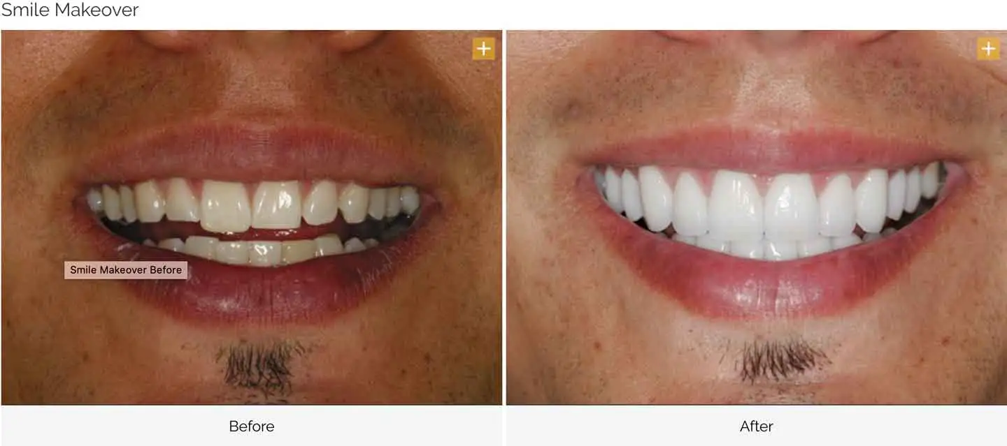 A smile Design made at GOREgeous Smiles 