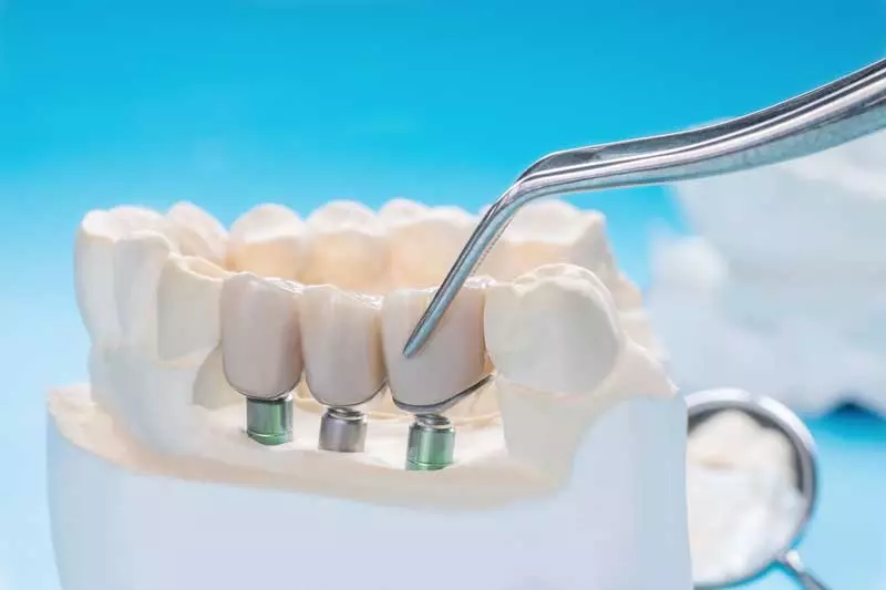 image of dental bridges