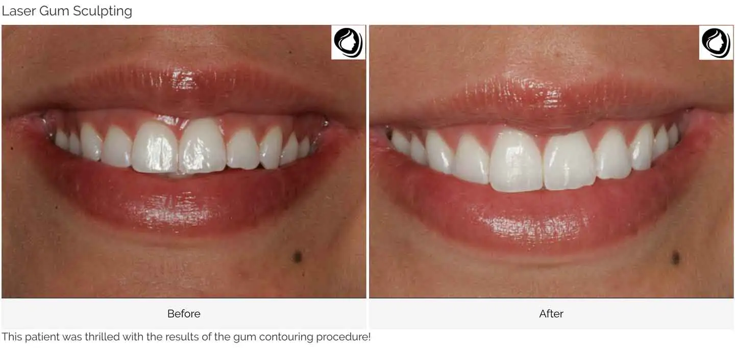 A smile Design made at GOREgeous Smiles 