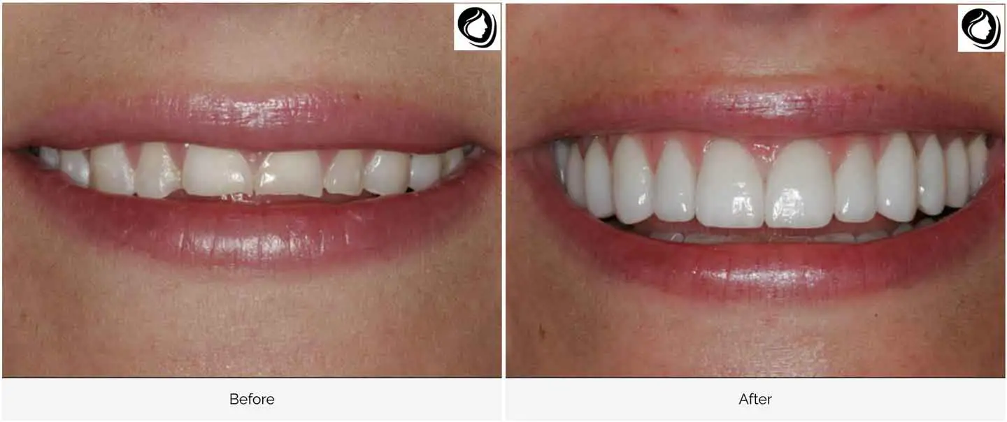 A smile Design made at GOREgeous Smiles 