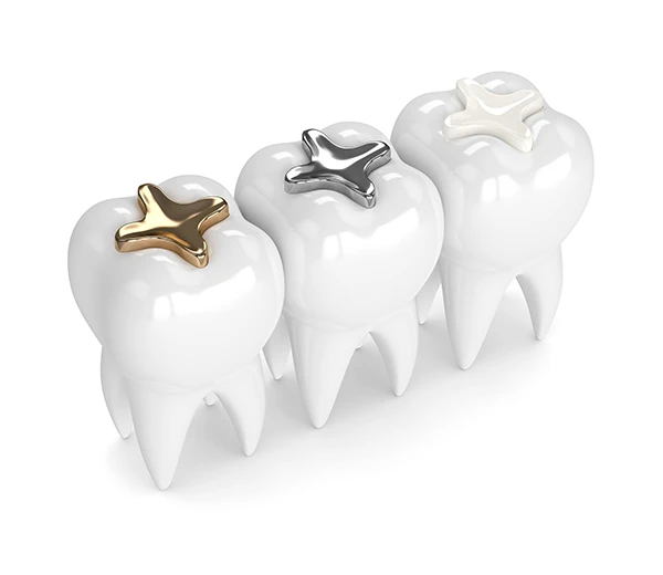 Three teeth each with a different dental filling material: composite, amalgam, and gold