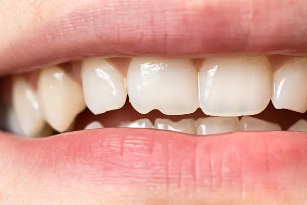 Close-up view of a chipped front tooth, highlighting dental damage.