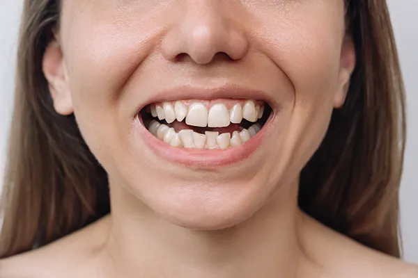 Close up of a woman's smile, which is crooked and in need of orthodontic treatment for better aesthetics and function.