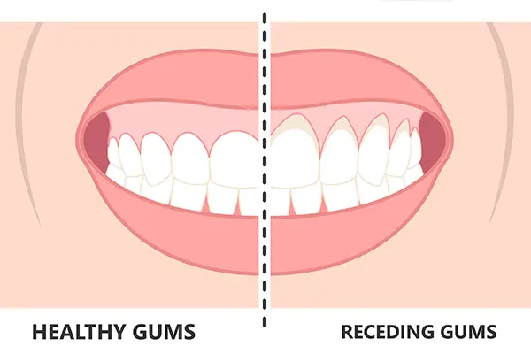Illustration comparing healthy gums and receding gums side by side, emphasizing the need for gum grafting treatment.