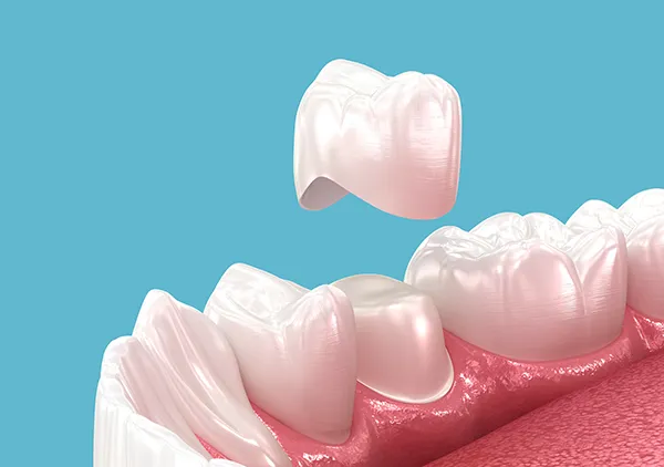 A pearlescent porcelain dental crown ready for placement on a prepared tooth.
