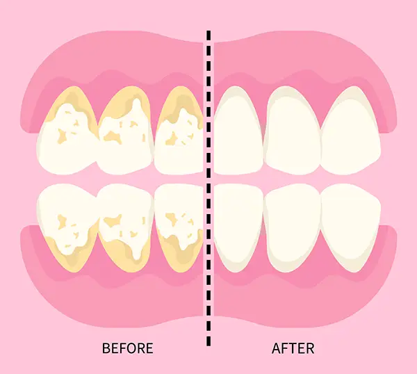 Before and after results of a professional teeth cleaning with tartar removal.
