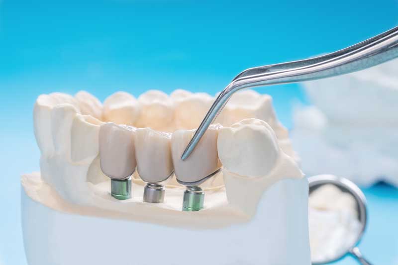 Dental Bridges: Types and Their Importance for Patients